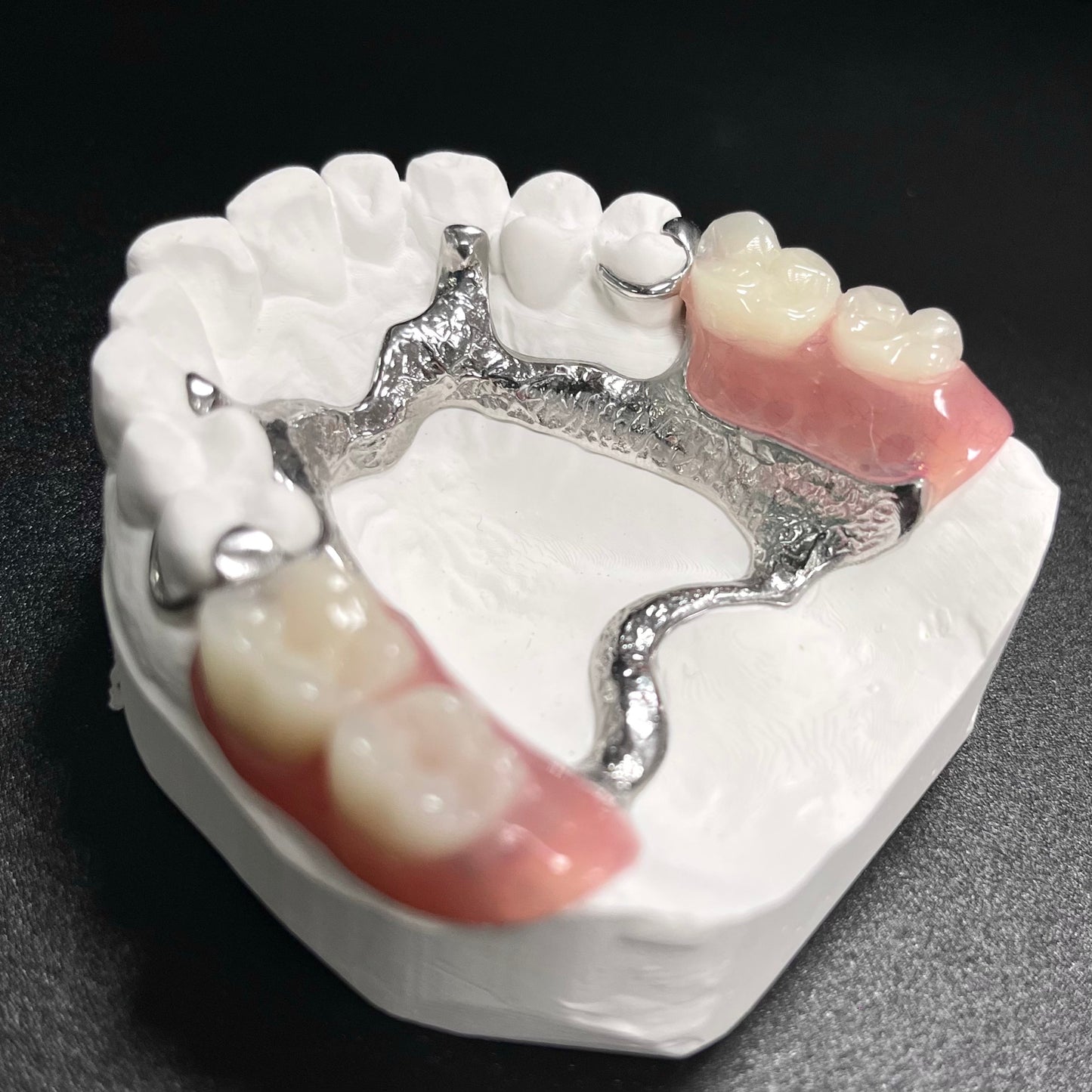 Vitallium Metal Framework