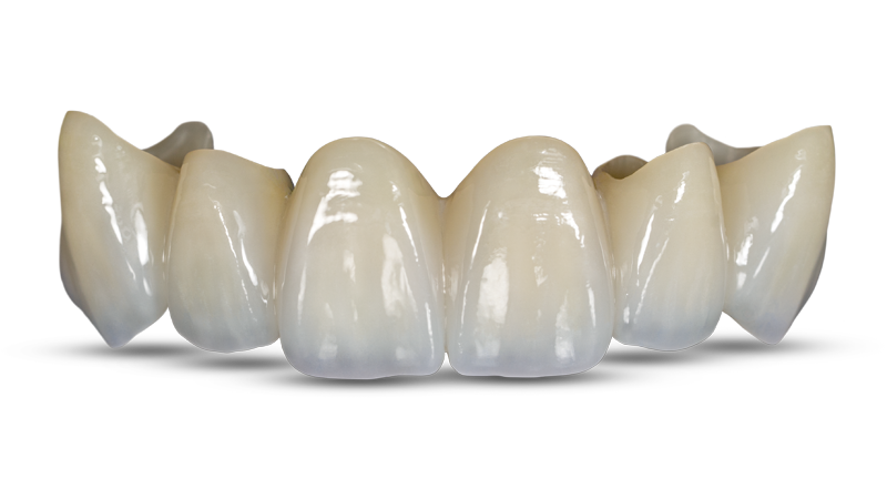 Layered Zirconia Crown