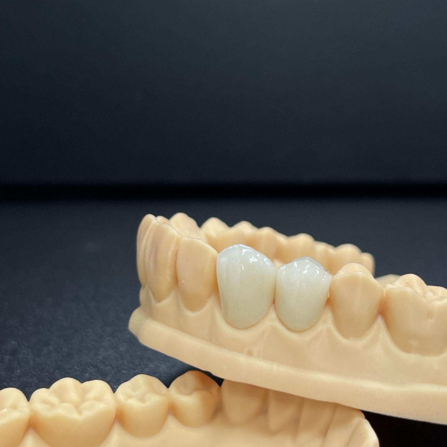 Porcelain Fused Metal Crown