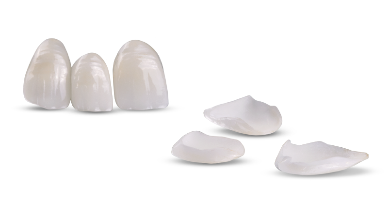 E.max Veneer