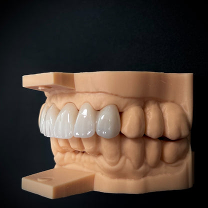 Full Contour Zirconia Crown