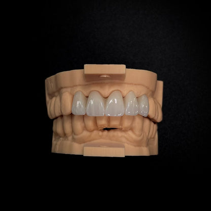 Full Contour Zirconia Crown