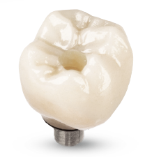 Implant PFM Crown