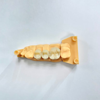 Full Contour Zirconia Crown